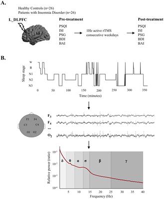 Restoration of abnormal sleep EEG power in patients with insomnia disorder after 1Hz rTMS over left DLPFC